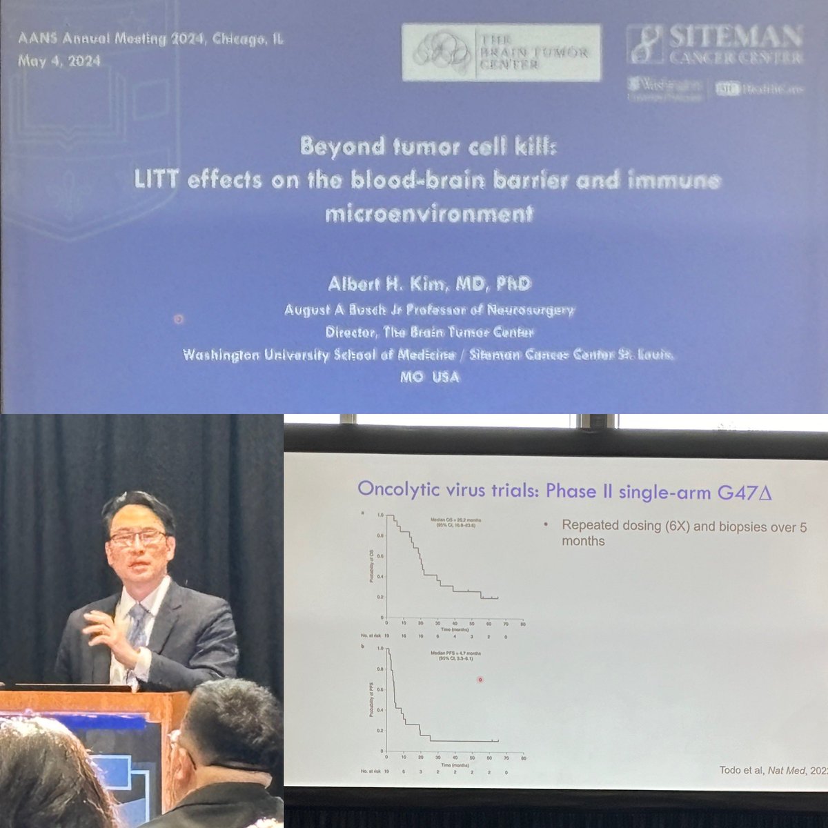 @AlbertHKimMDPhD on the effects of LITT on the BBB and microenvironment @WashUNeurosurg #AANS2024 #whatmatters2me @AANSNeuro @IsaacYangMD @UCLAHealth @UCLANsgy @HarborUCLA @HarborUCLASurg #skullbase