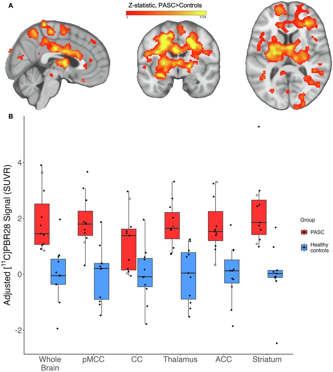 Die erste Studie, die eine Neuroinflammation im Gehirn von #LongCovid-Patienten zusammen mit Hinweisen auf Gefäßschäden dokumentiert

Patienten mit #LongCovid - langfristigen Symptomen wie Hirnnebel, Fatigue oder Schmerzen in den Monaten oder Jahren nach #COVID19 - weisen eine …