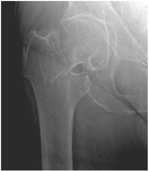 Controlling hip fracture pain can be a real, well, pain. EPs have used ultrasound to perform femoral nerve blocks and fascia iliaca blocks for some time, but @EMNSpeedofSound says pts receiving PENG blocks have significantly lower pain. tinyurl.com/3v698t56 #FOAMed #FOAMus
