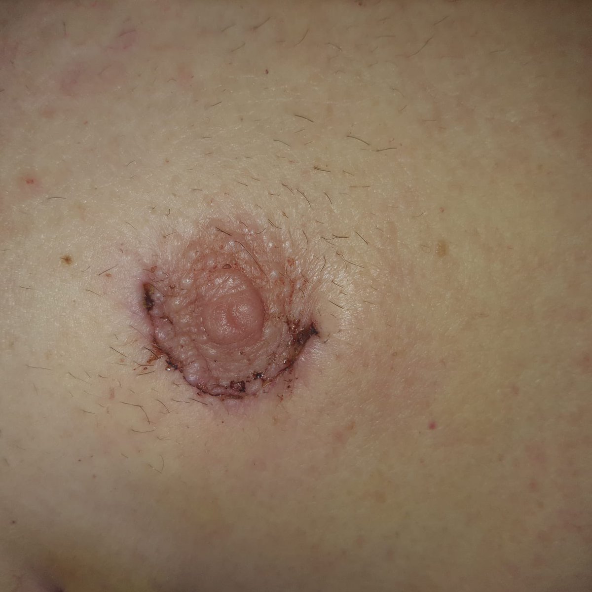 State-of-the-Art #Surgery

A few months ago, one of our residents sent me this picture; a postoperative wound from one of my patients (with permission to share)!

Can you imagine that this is the primary incision in men for an open-heart operation to repair the #mitralvalve,