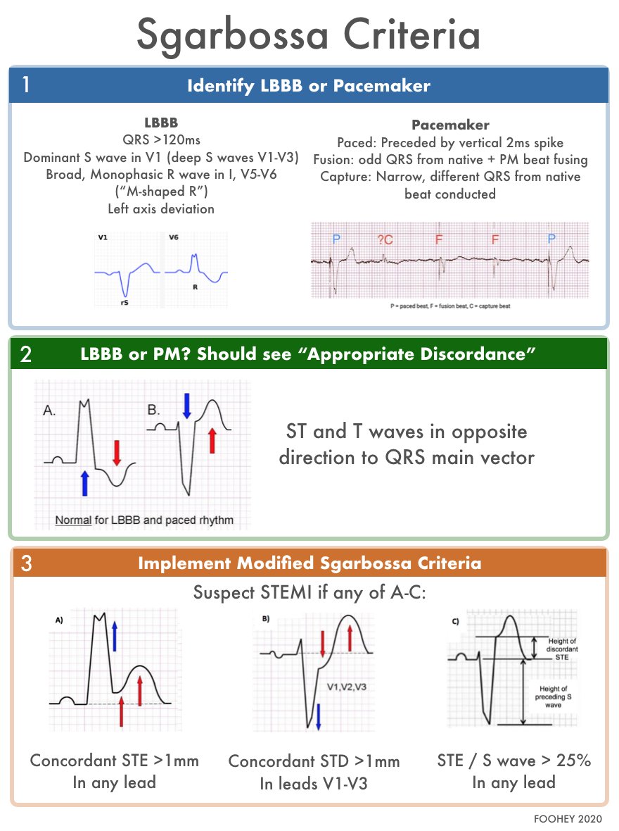 🔴 Modified Sgarbossa Criteria - Diagnostic Checklist for diagnosing MI in LBBB or Pacemaker

Summary by - Dr. Sarah Foohey @SarahFoohey
#Sgarbossa #Criteria #Modified #Diagnosis #Checklist #EKG #electrocardiogram #ecg #cardiology #lbbb #CardioEd #MedEd #cardiotwitter #cardiology