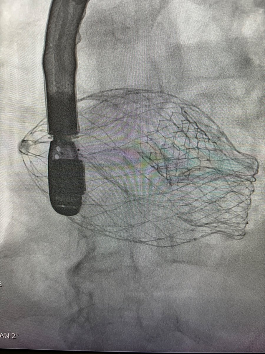 Proud of @CardioUva Advanced Cardiac Valve team for our first @4cmedical transeptal #TMVR for a patient with no other options. Terrific valve design, phenomenal engineering, and a world-class team! @4cmedical Looking forward to future cases!