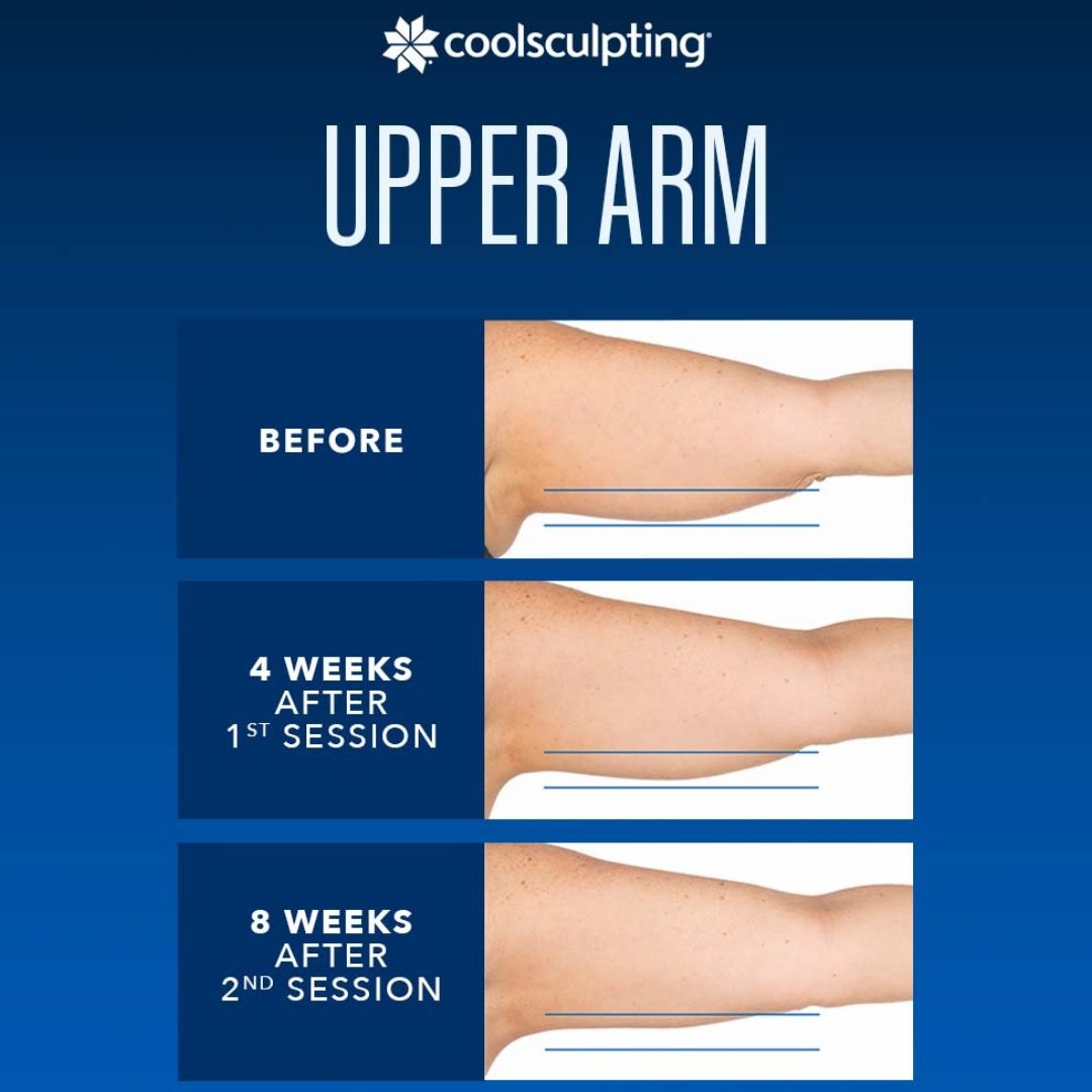 Say goodbye to stubborn upper arm fat with CoolSculpting! Look and feel your best this summer ☀️💪 #CoolSculpting #UpperArmFat #SummerBody #ConfidenceBoost