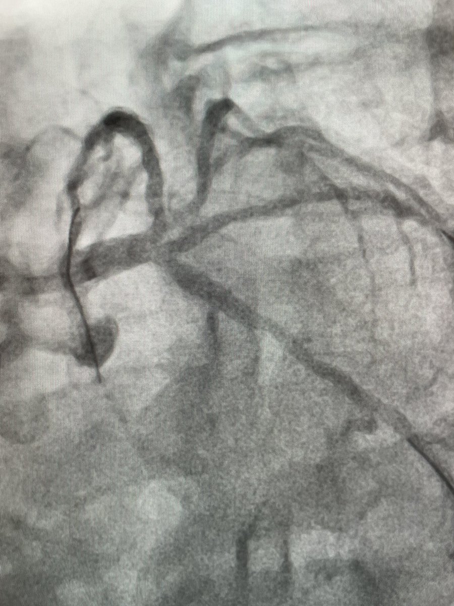 70y man admitted w/ UA. Multiple PCIs with several stents in mid-distal LAD, Intermed branch, CX and RCA. Pre-dil w/ Wolverine followed by trissing-balloon with 03 DCB. Would you accept this suboptimal angiographic result to avoid more stents in this complex trifurcation?