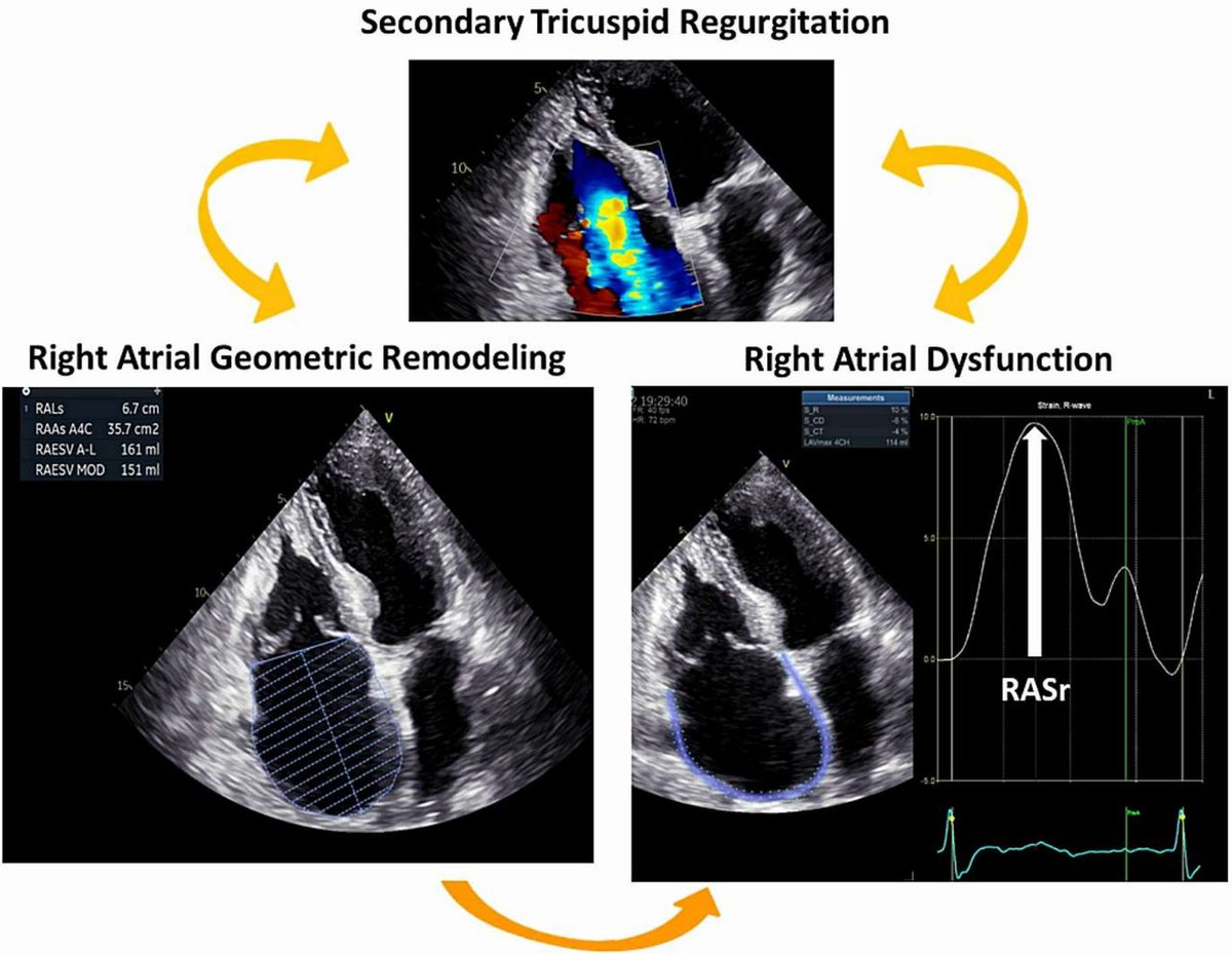 Right atrial function, a mostly ignored but very valuable parameter in patients with secondary tricuspid regurgitation heart.bmj.com/content/early/…