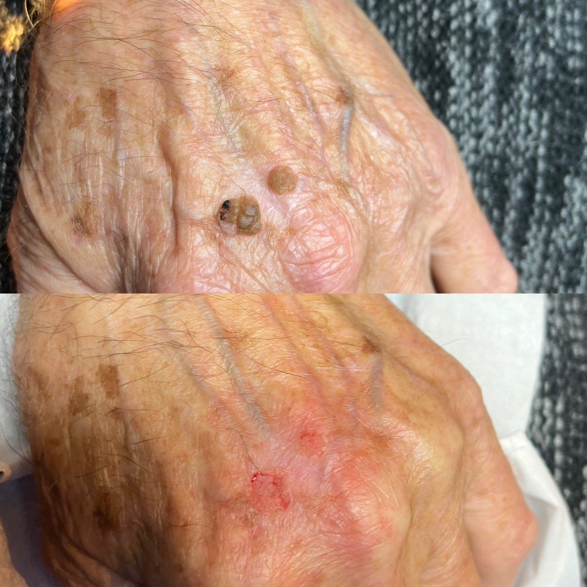 Before and After removal 
#halcyondsysskincare 
#advancedskincare 
#skinleisonremoval