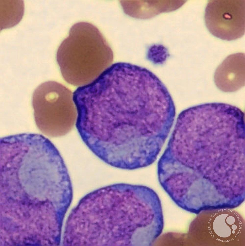 Blasts with cup-like nuclei in acute myeloid leukemia with NPM1 mutation. This AML also had a concurrent FLT3 mutation. | ASH Image Bank | American Society of Hematology imagebank.hematology.org/image/64707/cu… #ASHImageBank