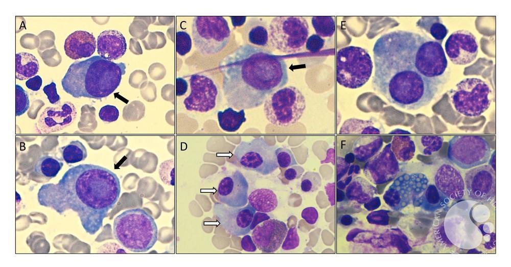 Plasmablastic myeloma: differentiating a high risk disease | ASH Image Bank | American Society of Hematology imagebank.hematology.org/image/63924/pl… #ASHImageBank