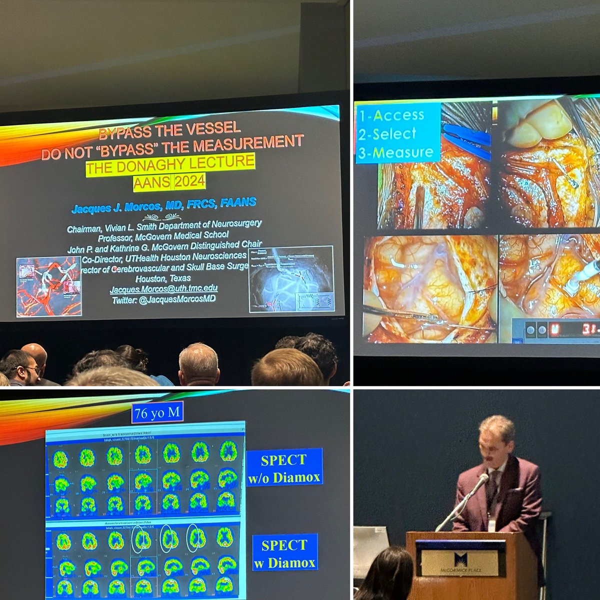 A wonderful Raymond M. Donaghy lecture on Pushing the Envelope in Cerebrovascular Lesions by Dr. Jacques Morcos! #AANS2024 @jacquesmorcosmd @UTHealthHouston @UTHealthNeuro @IsaacYangMD @UCLANsgy @AANSNeuro #WhatMatters2Me