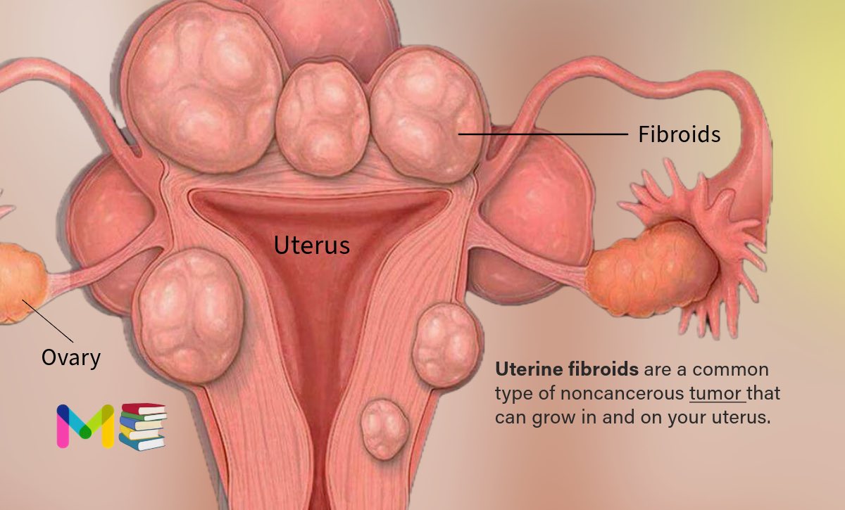 ✍️ Writing on New Topic (UTERINE FIBROIDS) Upcoming full Note..📚 [All causes of disease short notes- wp.me/Pe4PUC-4m

#uterinefibroids