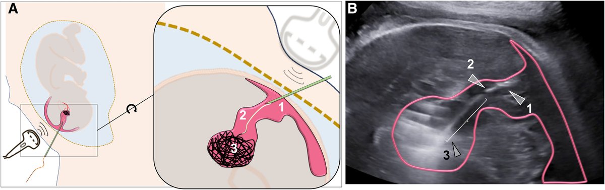 AJOG Images in Obstetrics: Prenatal treatment of a vein of Galen malformation by embolization and 1-year follow-up - Illustration of the technique with a patient with a vein of Galen malformation. ow.ly/TK3g50R3Y0C