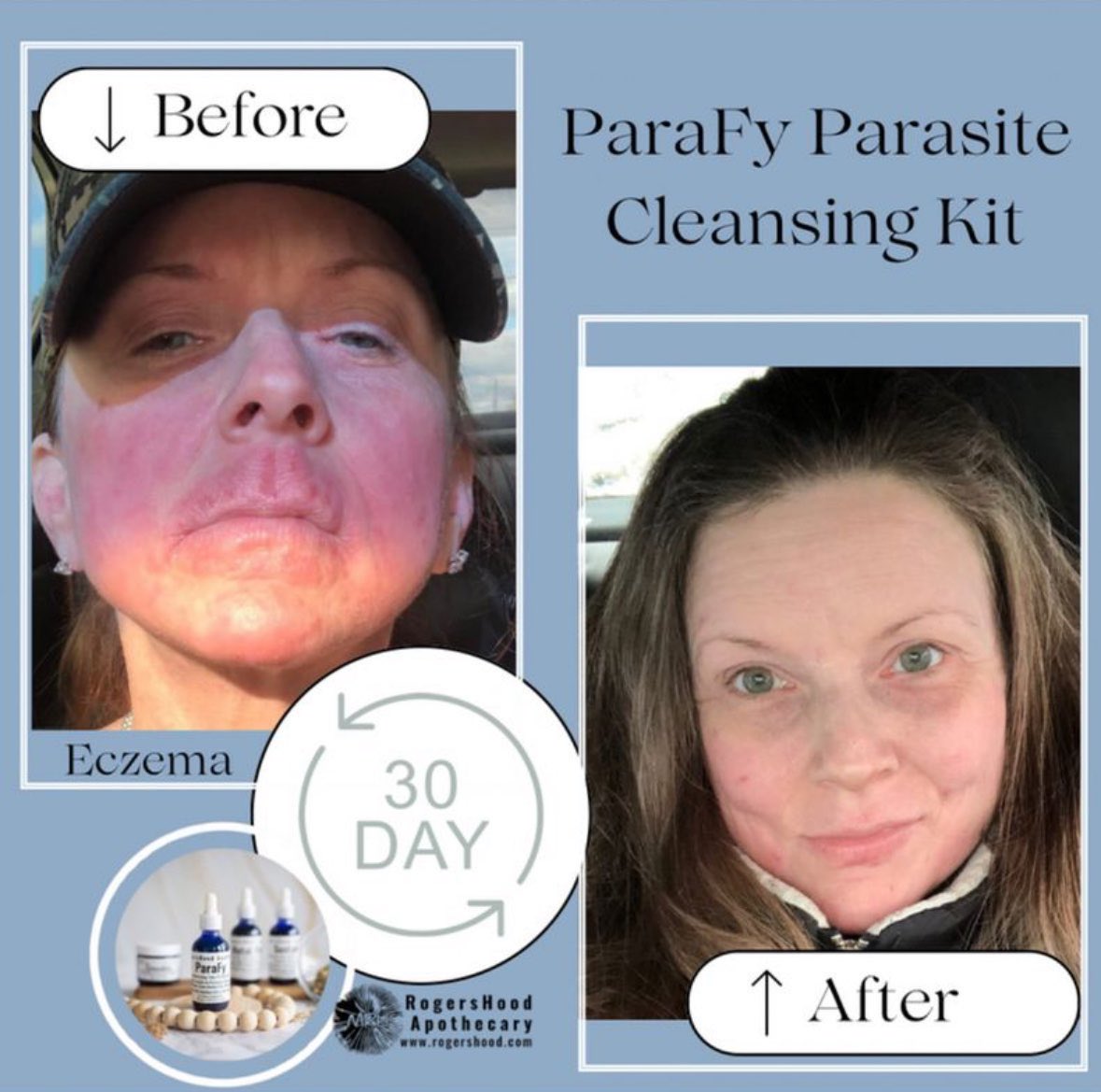 Have you taken your before and after with the parafy parasite cleanse kit? After 30 days!!! #BeforeandAfter #parafycleansing #detoxing #skincareroutine #internalhealing #rootcause #rootsource #cleansing #summerdetox #eczema