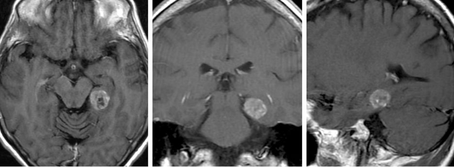 What approach is the best way to expose posterior parahippocampal lesions as seen in the image above? Bonus: What are some advantages of this approach over the alternatives? #MedTwitter #Neurosurgery #NSGY #surgery