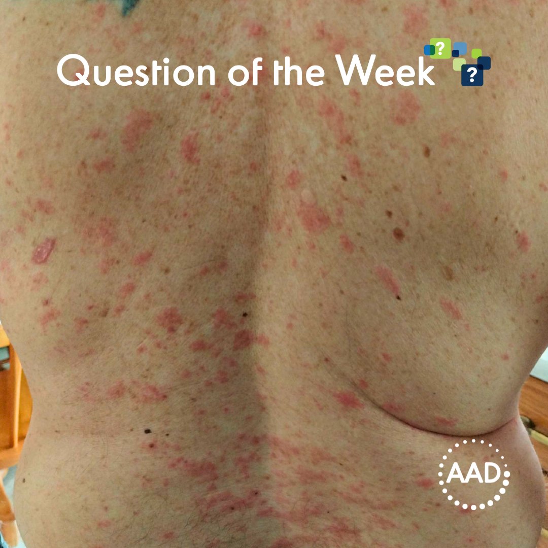 Which medication triggered this eruption? ➡️ A 68-year-old man presents with diffuse pruritic pink edematous papules, increasing in number over a period of weeks... #AADmembers: Submit your answer for CME in AAD Question of the Week! 📌 learning.aad.org/URL/ExamQuesti… #dermtwitter