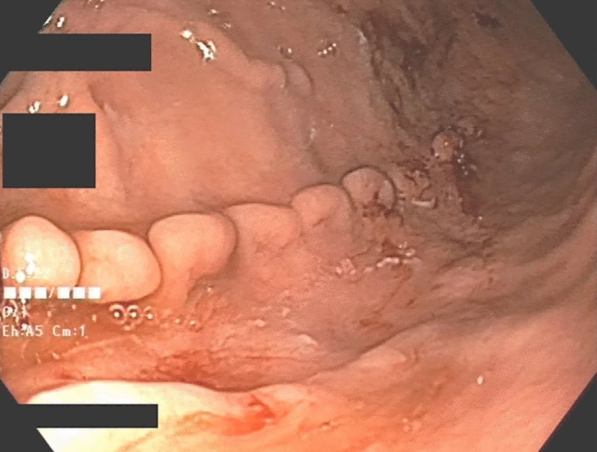 Endoscopic view of the stomach of a patient with abdominal pain and anaemia. What’s the diagnosis?