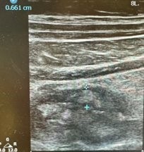 #IBDHorizons24 Fausel

Case:
38yo with #Crohns
💉previously in remission on 90mg UST every 8 weeks

New findings:
😖pain
🚽diarrhea
🧪calprotectin level of 2000 mcg/g
🌀IUS shows the following image
🤔What next steps to assess & manage with the patient?

If preg, changes to plan?