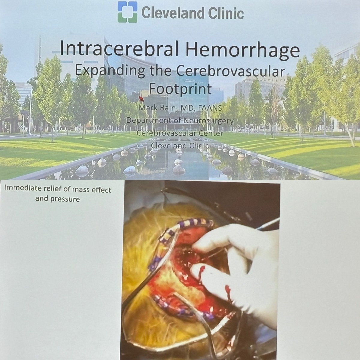 @bainmd on ICH @ClevelandClinic @CleClinicNS #AANS2024 #whatmatters2me #skullbase #AANS2024 #whatmatters2me @AANSNeuro @IsaacYangMD @UCLAHealth @UCLANsgy @HarborUCLA @HarborUCLASurg #skullbase