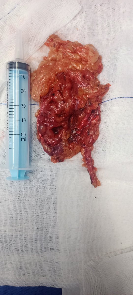 Laparoscopic Right Nephrectomy for symptomatic infected Non Functioning Kidney in male pt 37 yrs old with IHD , uncontrolled hypertension and CKD.