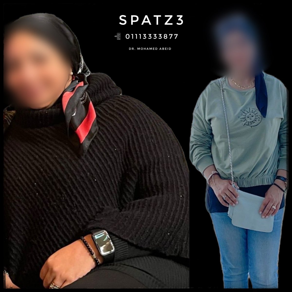 MohamedAbeid's tweet image. 100 % EWL
#SPATZ3 
#WeightLoss 
#Obesity