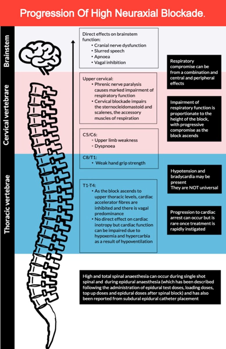 Total spinal anaesthesia in #ObAnes: a narrative review
🧠Spinal after epidural most common precipitant reported recently
🧠Good outcome when treated promptly
🧠Poor outcomes associated with delayed recognition and inadequate resuscitation

doi.org/10.1016/j.ijoa…