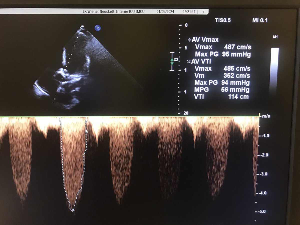 81y/o w admitted with decompensated heart failure. Initial TTE report stated no sign. valvular abnormalities, but Echo quality was poor. 

Great example how valuable a second look can be. If you can‘t tell what’s going on, seek help or reschedule #echofirst #TTE #heartfailure