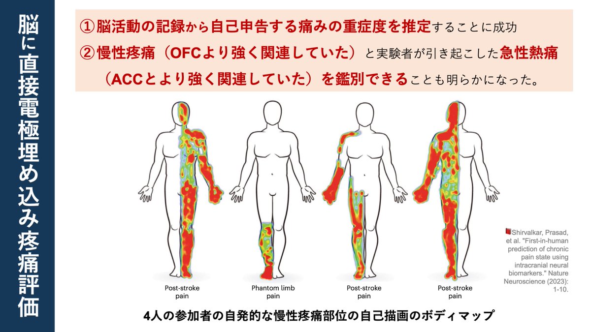 疼痛メカニズム評価の使用💡 整形系理学療法士148名の回答！ 2023年のNature Neuroscience誌で, 一風変わった疼痛評価が報告されました それは “脳に直接電極を埋め込み疼痛を評価” です 🌱note：note.com/super_human/n/… 確かに “直接” 評価できれば最善ですよね😲