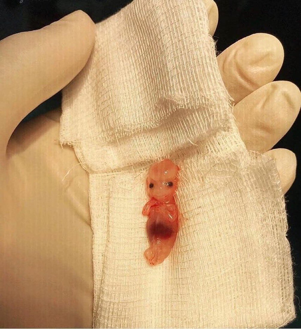 An image of an 9-weeks ectopic pregnancy baby. As sad as it is, it shows the wonders of God's creation and debunks the big bang theory. Credits: @DocOmeiza