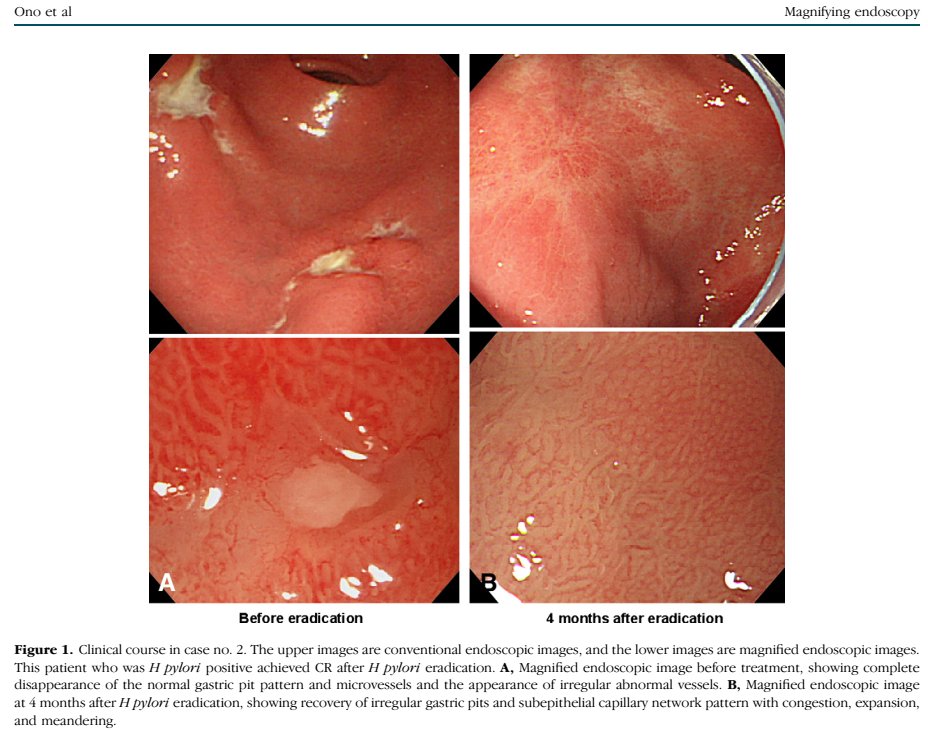 Gastric MALT lymphoma has several endoscopic appearances:

- ulcers/erosions
- submucosal/infiltrative
- ulcero-infiltrative
- exophytic/mass-like/proliferative
- non-specific findings (eg. discolourations)

#MedTwitter #GITwitter