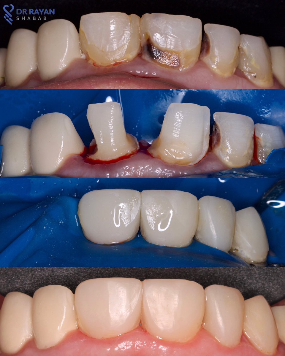 dr_ryn7's tweet photo. 🪄حشـوات تجميلـية فقـط.

 Direct Composite Restorations #11.12.13.21 👨🏻‍🎨💙
@laser_dentc https://t.co/5LHtbsvx2b