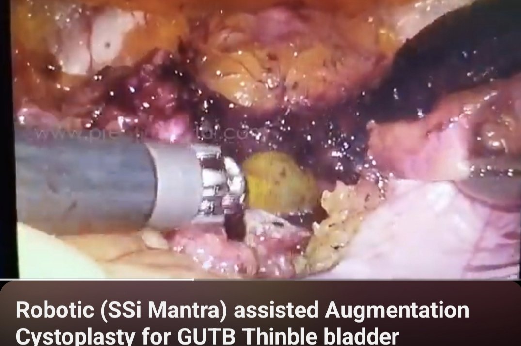 youtu.be/Jjmvk9FVqFY Robotic Assisted ( SSI Mantra) Augmentation ileocystoplasty done. 28 Years Male with intractable storage LUTS, cystoscopy - Small capacity bladder < 100ml, MCUG - small capacity bladder ( below lower border of sacrocoiliac joint) Right Solitary…