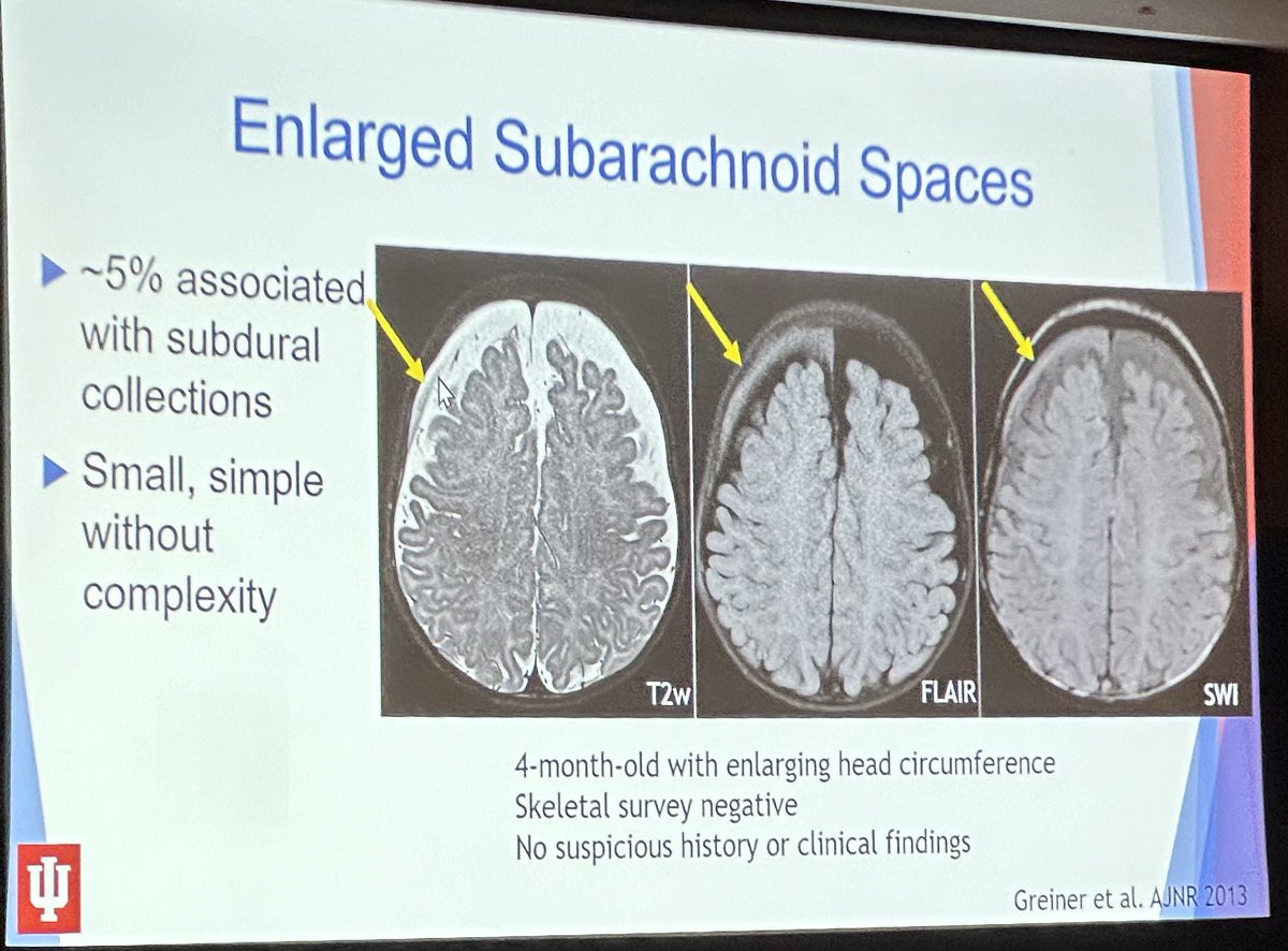 Dr. Rupa Radhakrishnan @RadRupa delivered an excellent talk on #AHT imaging! Bringing important clinical perspectives of pediatric neuroimaging to #ISMRM24 #Singapore @The_ASPNR @ISMRM @RileyChildrens