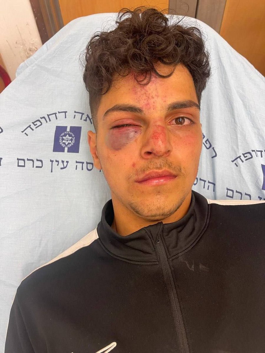 Israeli Jewish settlers violently attacked Palestinian boy Adam al Resheq in Jerusalem’s Old City!