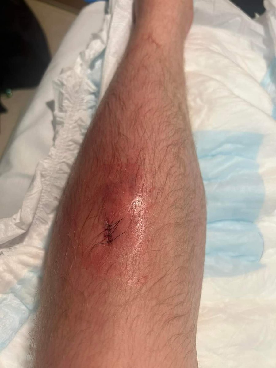 @espnmma That was the actual cut. Terrible stoppage. Your photo is showing the blood running down the shin, which makes it look worse than it was. No gracture just a few stitches