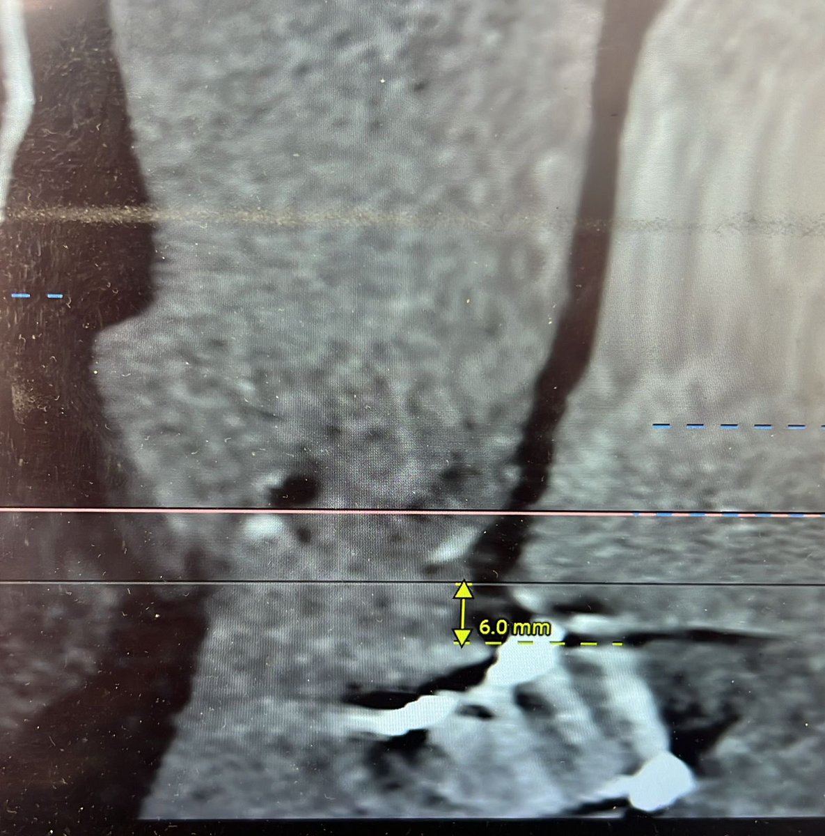 Post MVR with ball in cage valve. Lvef 25%. Now severe AS. Planned for Tavr. Large annulus. Low Lca height. Aortomitral distance 6mm. How to plan? Which valve? 
@chris_malkin4 @drrao_TAVI @evandrofilhobr @DrGopalamurugan @Anoop_Agr @drandrewsharp @tavrkapadia #CardioTwitter