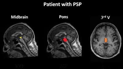 #DeepLearning method for MRI analysis of brainstem & ventricles in patients with progressive supranuclear palsy doi.org/10.1148/ryai.2… @unibait @KingsIoPPN #MRI #PSP #ML