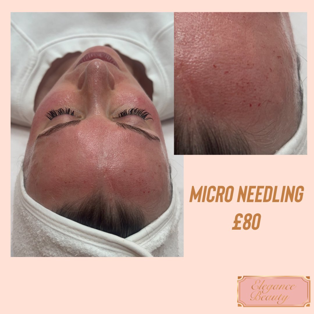 💐Micro-needling💐

My aim is to cause slight trauma to the skin, this helps stimulate your skin’s healing process, so it produces more collagen and elastin. These proteins keep your skin firm and smooth.

#microneedling #milliondollarfacial #mesotherapy #margate #thanet