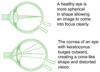 I wish I could have considered lasik. Instead, my eyes decided to lasik themselves through a degenerative eyes disease called keratoconus where the cornea thins and moves from parabolic shaped to cone shaped.