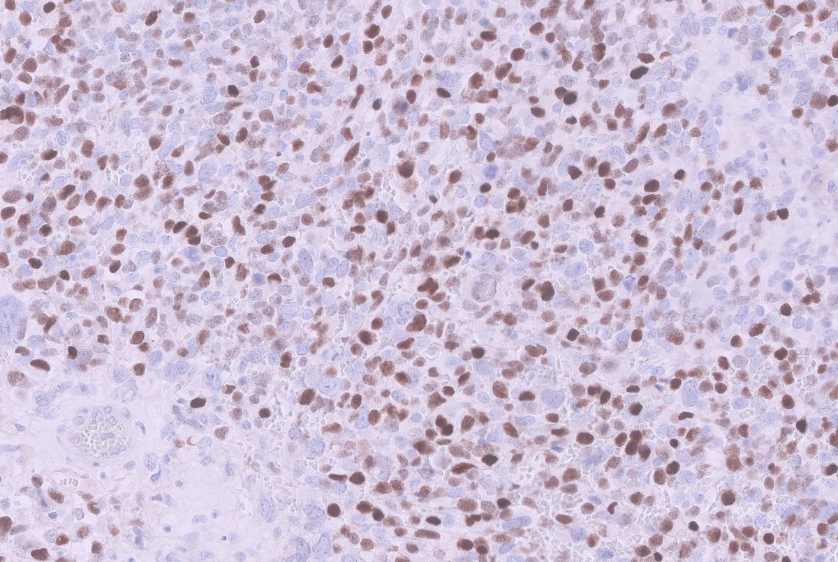 Uterine mass. This is D&C. What is this positive IHC?