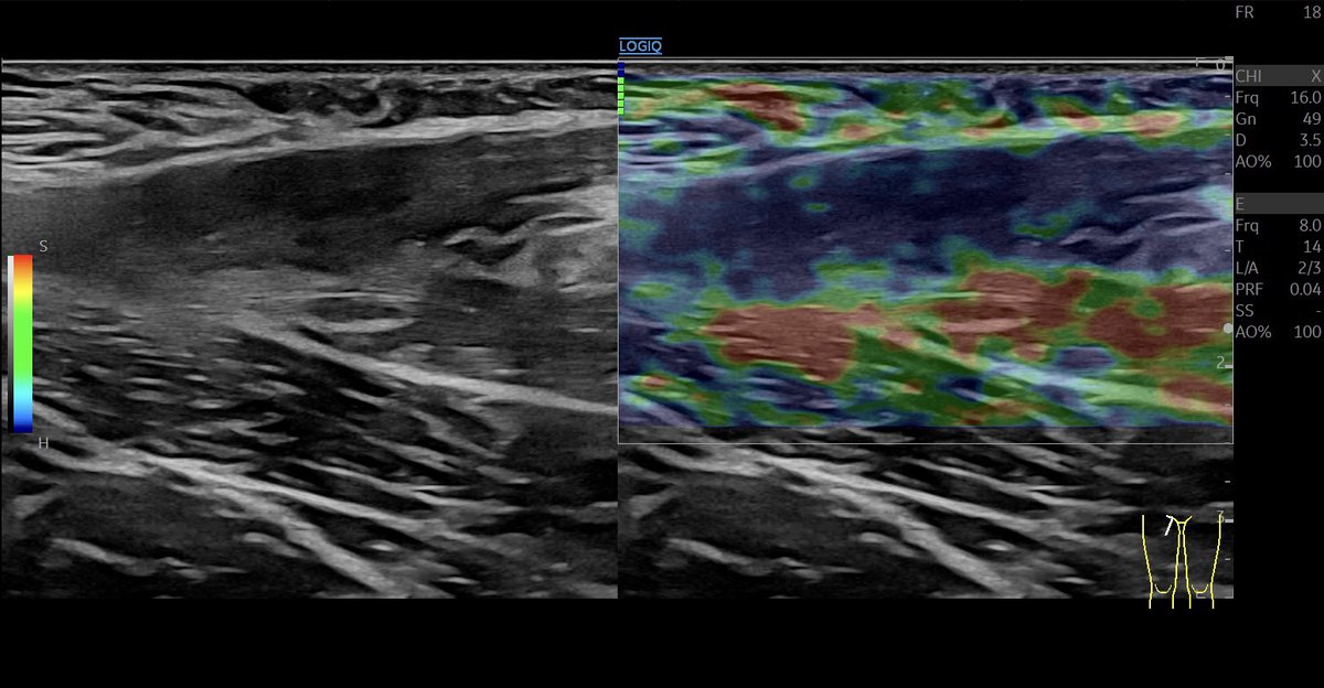 Scar tissue in #elastography 8w after #muscleinjury of the adductor longus #mskus #pocus #pocushub #GElogiqE10r3