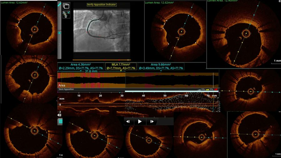 Follow-up #intravascular #imaging in a patient who had an issue. What do you see in this image submitted by Ganesan Nambirajan 🇮🇳 and selected for #EuroPCR? Test your knowledge here ➡️❓pcronline.com/Cases-resource… #imagefirst #medicalimage #interventionalcardiology