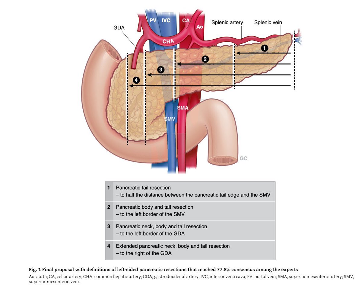 Left side pancreatectomy 🙊 do we speak the same language?! 🌍 International Delphi consensus 4️⃣ resection categories based on anatomy + additional procedures / technique 🔪🤖 👉 Distal is not just “distal”… academic.oup.com/bjs/article-ab…