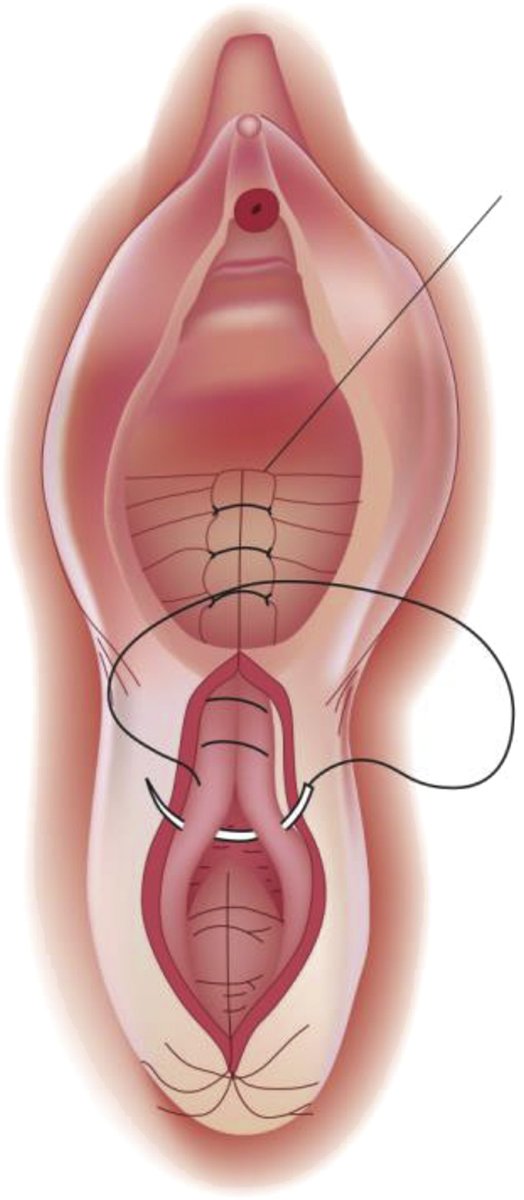 AJOG Expert Review in Labor:  Repair of episiotomy and obstetrical perineal lacerations (first-fourth) - Repair of second-degree laceration ow.ly/fczQ50P1Zuj
