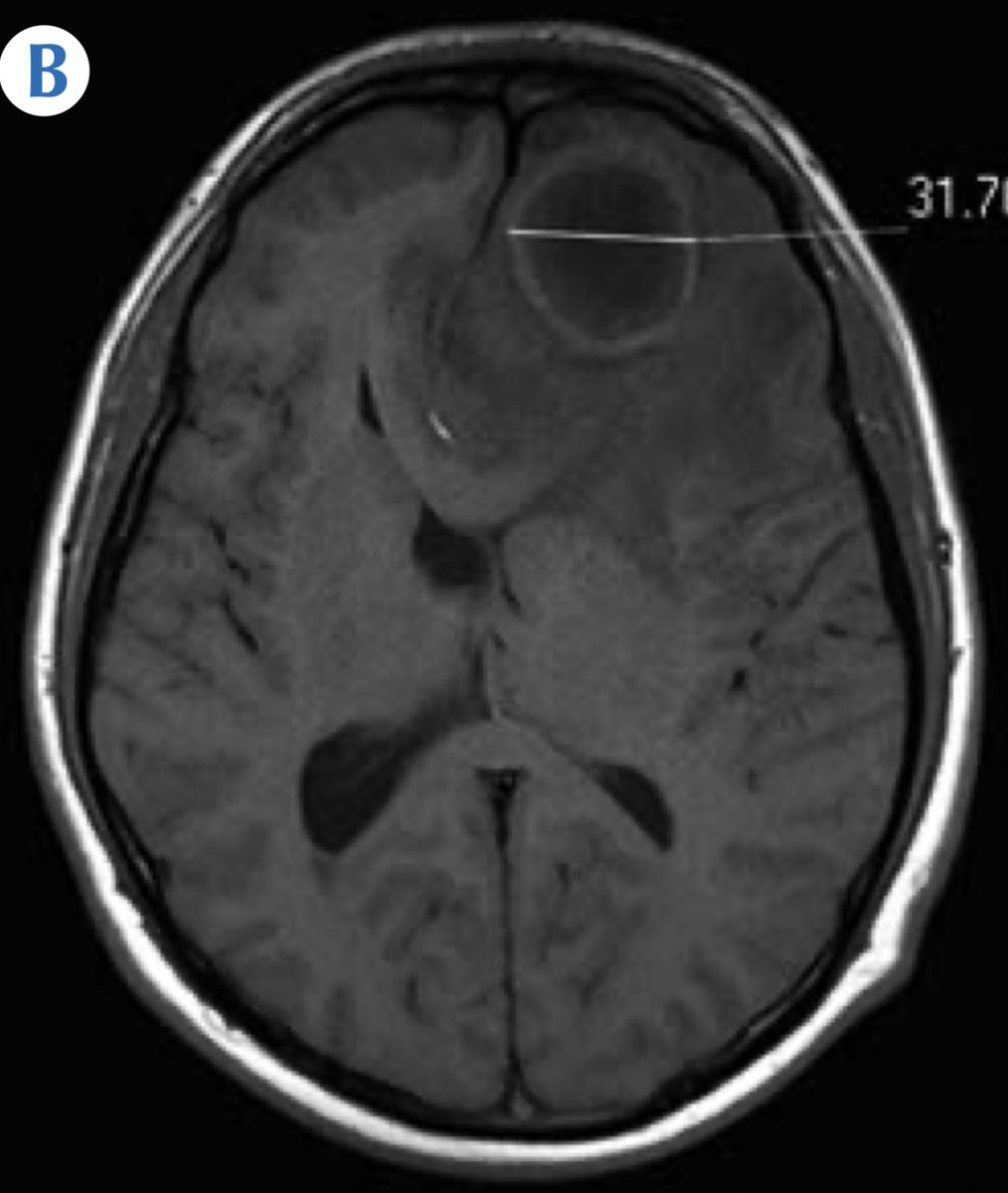 ardila11 (@alvaroardilao) on Twitter photo ABSCESO TUBERCULOSO FRONTAL IZQUIERDO ABSCESO TUBERCULOSO FRONTAL IZQUIERDO