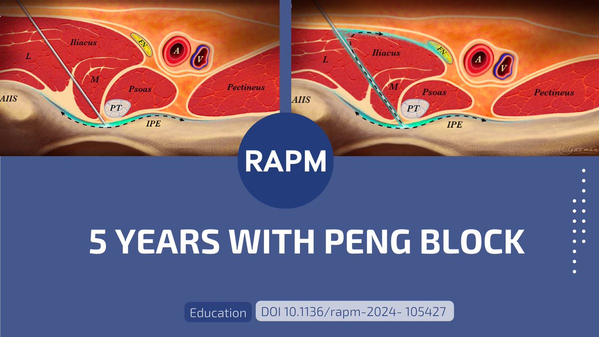 The PENG block has revolutionized anesthesia in hip surgery. ▶️ What is the optimal volume for a motor-sparing effect? ▶️ Is it effective for hip fracture/arthroplasty/arthroscopy? 👉 Read all about it here: bit.ly/3QNhJuX @lgiron86 @DrPhilipPeng