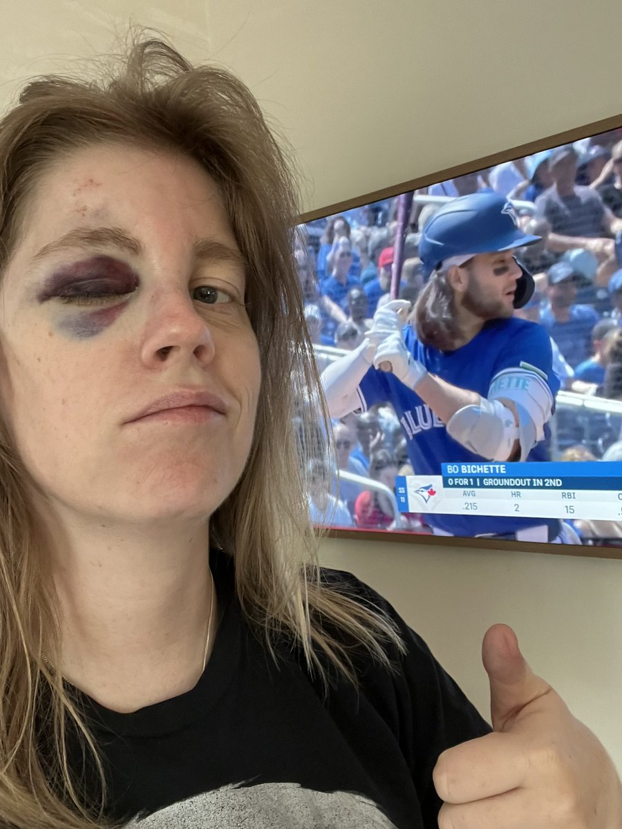 Hey @BlueJays I got my face mashed in by a 110mph foul off Bo Bichette's bat. I didn't even get the ball. I even stayed till the end of the game. Any way you can hook a girl up? #tothecore #bluejays