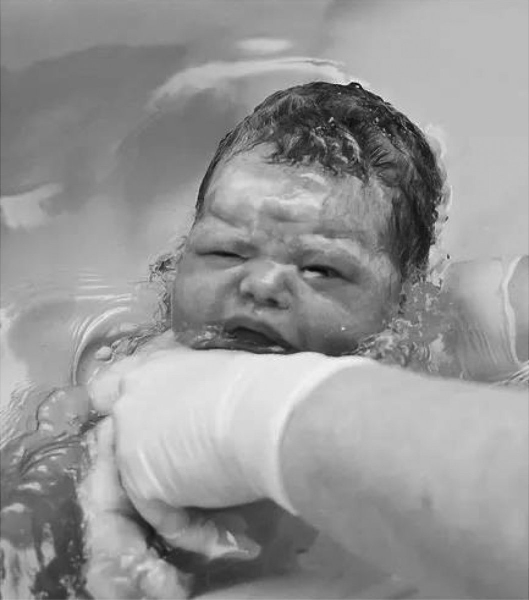 Water birth: a systematic review and meta-analysis of maternal and neonatal outcomes ajog.org/article/S0002-…