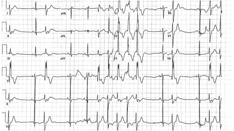 Connect the dots;
A patient with this physical characteristics 
Periodic hypokalemic paralysis
Abnormal ECG 👇
What is the likely diagnosis?
What are the characteristics facies in this image?
Treatment ?
#MedTwitter #MedX #MedEd #Medicine #rare #genetic #Clinical #medicalstudent