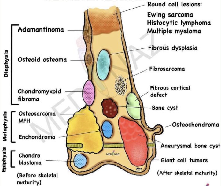 Sites of bone tumors...