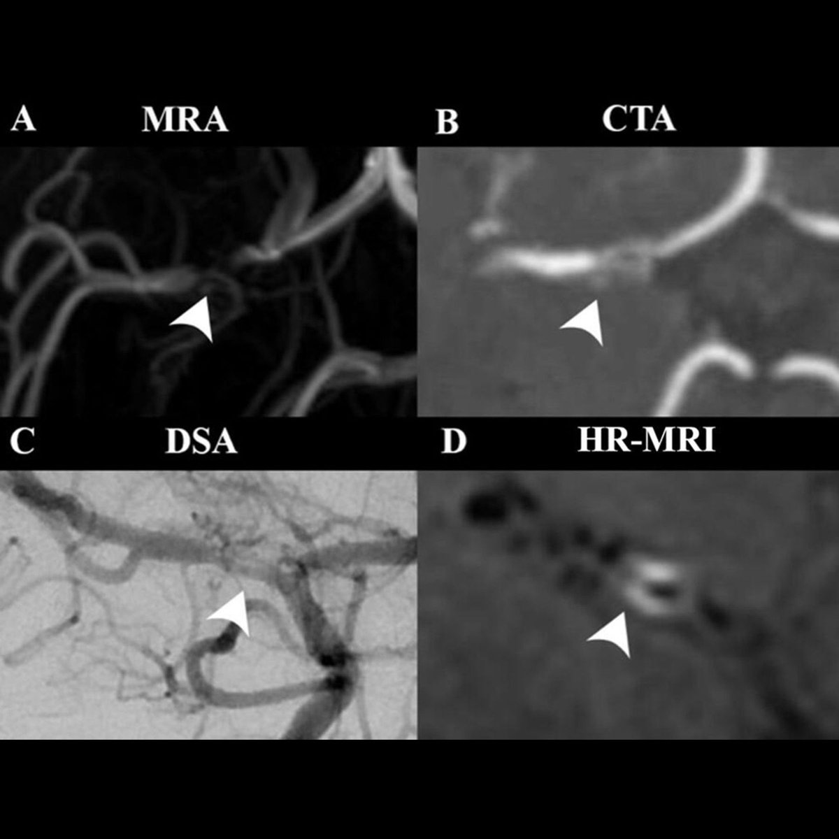 Comprehensive review of imaging in diagnosing intracranial atherosclerotic disease (ICAD)!  From CT and MR angiography to high-res MRI and CTP scans, new techniques reveal detailed plaque characteristics and blood flow dynamics.  🧠🔍 #StrokeAwareness bit.ly/4bI4Zh7