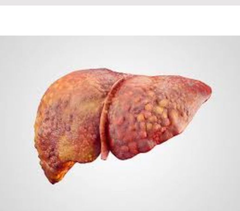 love4health_'s tweet image. Signs that your liver is full of Toxins,what a healthy liver looks like and Treatment 

A thread 🧵